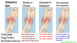 Classification of Fracture 