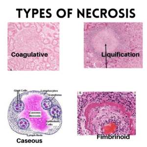 TYPES OF NECROSIS