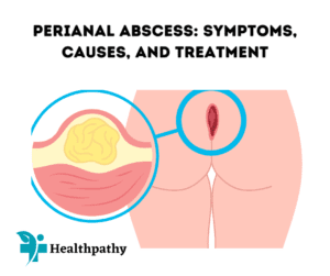 Perianal Abscess: Symptoms, Causes, and Treatment