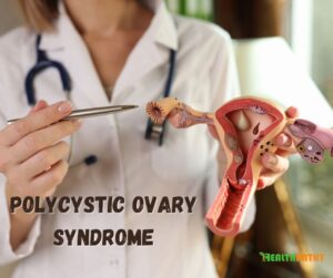 Polycystic Ovary Syndrome