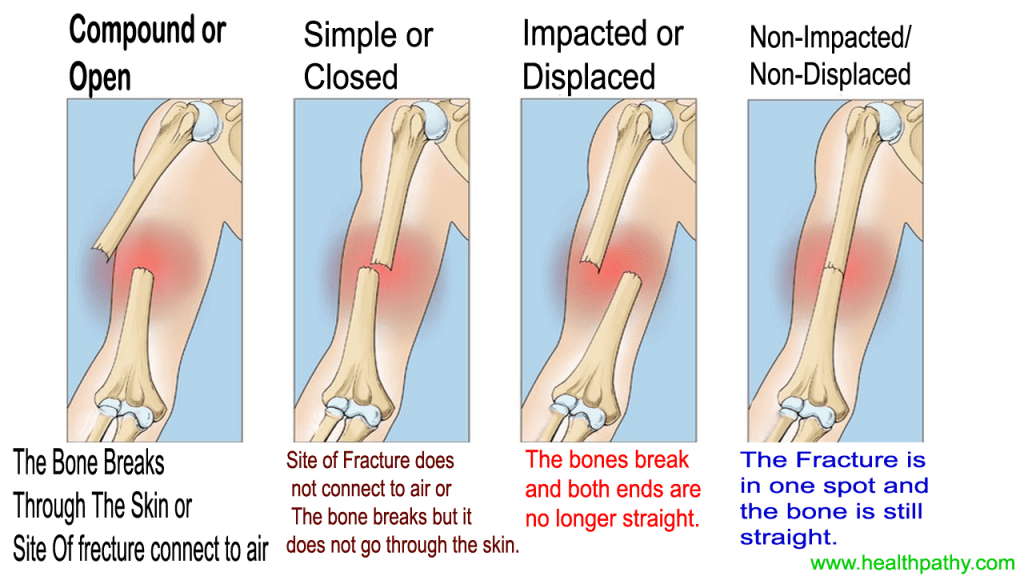 Classification of Fracture definition, sign and symptom medical notes
