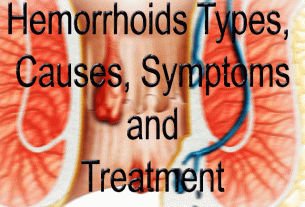 Hemorrhoids-causes-symptoms-treatment