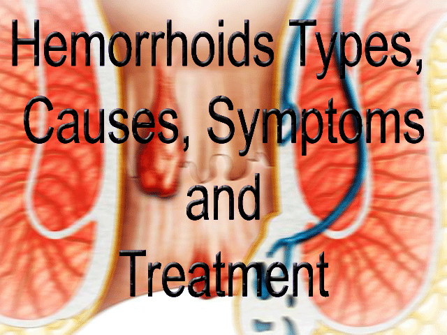 Hemorrhoids-causes-symptoms-treatment