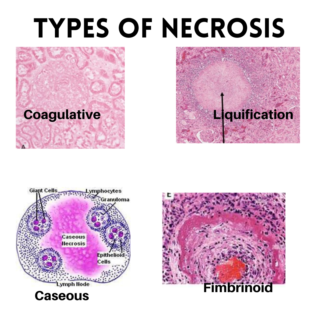 Necrosis: Pathology, Types & Causes- Healthpathy