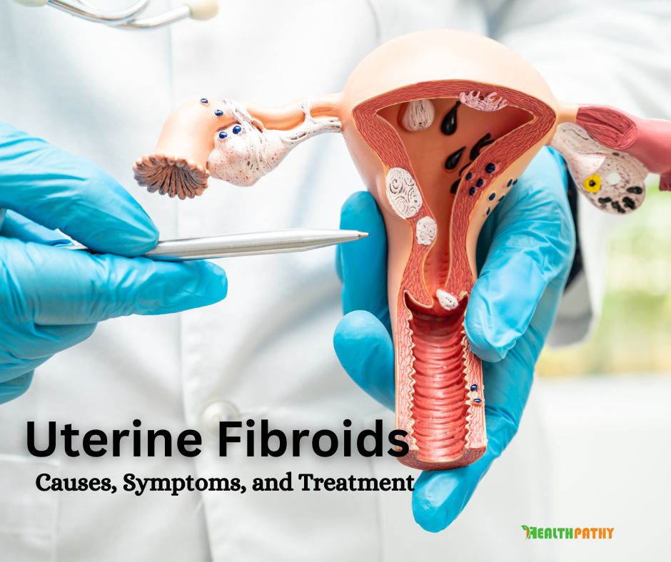 Uterine Fibroids Causes, Symptoms, and Treatment